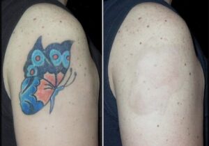 Before and after pictures of a butterfly tattoo on a man's arm.