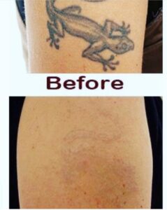A woman's tattoo before and after treatment.