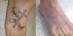A woman's foot with a cross tattoo before and after.