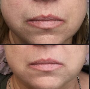 File_006(1) - Elmira Studio A woman's lips before and after lip injections.