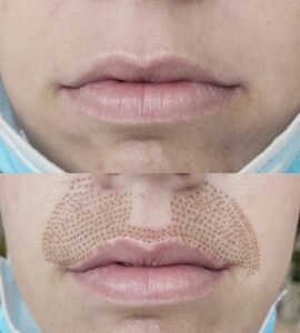 A woman's lips before and after lip injections.