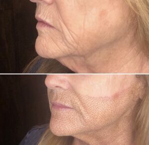 Before and after photos of a woman with wrinkles on her face.