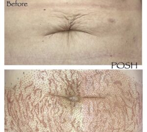 Posh tummy tuck before and after.