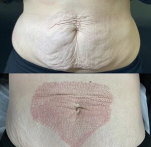 Tummy tuck before and after before and after before and after before and after before and after before and after before and after before and after.