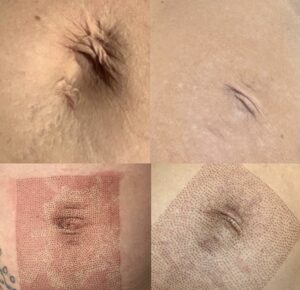 Tummy tuck before and after.