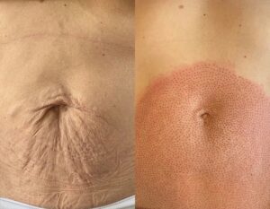 Tummy tuck before and after.
