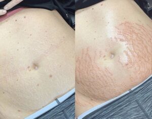 Two pictures of a woman's stomach before and after treatment.