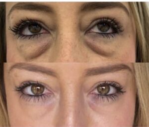 Before and after pictures of a woman's eyelids.