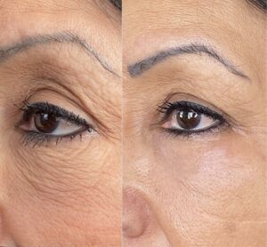 Before and after pictures of a woman's wrinkles.