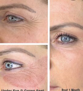 Under eye & crow's feet treatment.