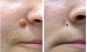 Before and after pictures of a woman's nose.