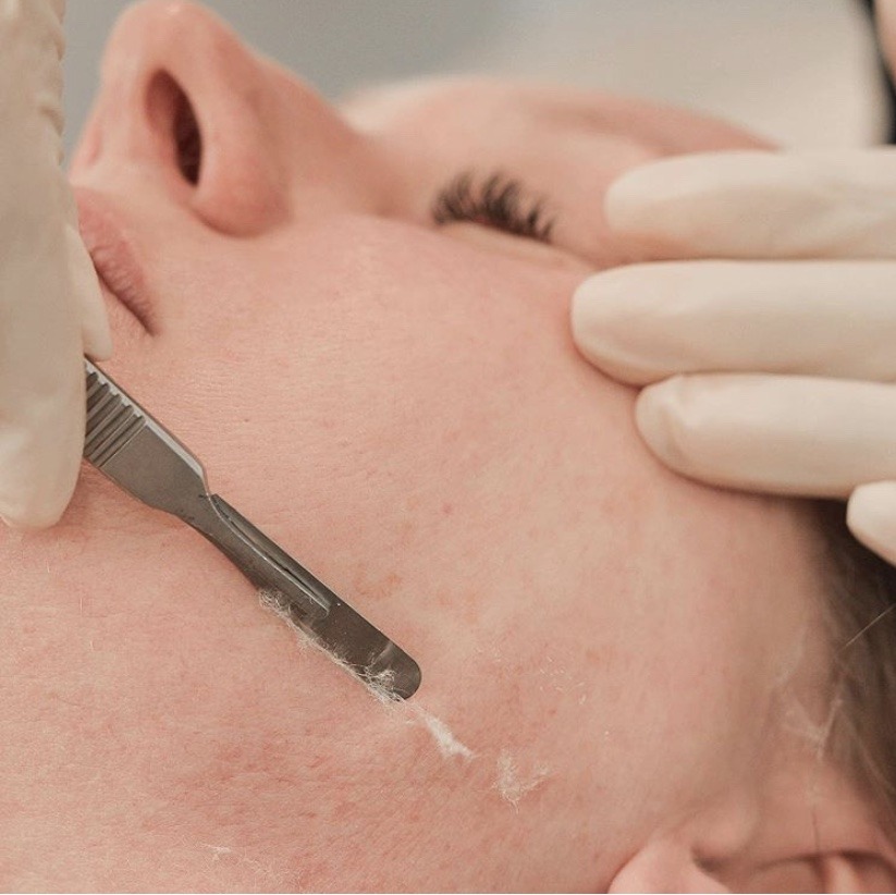A woman is getting her face waxed by a doctor.