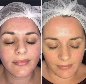 A woman's face before and after a facial treatment.