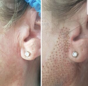 Before and after photos of a woman's ear piercing.
