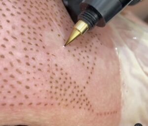 A tattoo is being done on a person's skin.