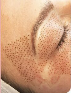 A woman's face with freckles on it.