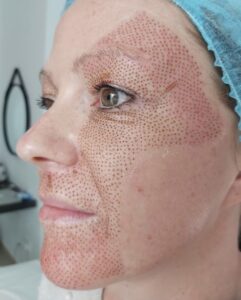 A woman's face with dots on it.