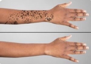 A woman's hand with a black mark on it.