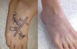 A woman's foot with a cross tattoo before and after.