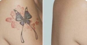 A woman with a butterfly tattoo before and after.