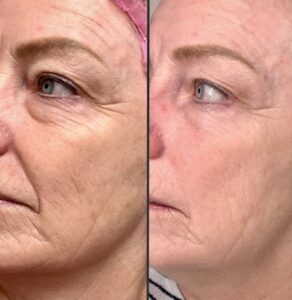 g6 - Elmira Studio Before and after photo of a woman with wrinkles.