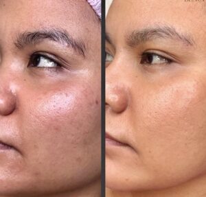 g7 - Elmira Studio Before and after photo of a woman's skin.
