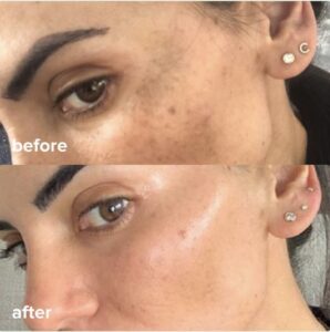 Before and after pictures of a woman's skin.