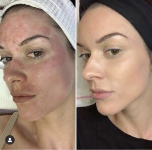 Before and after photos of a woman with acne.
