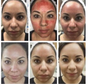 microneed3 - Elmira Studio A woman's face before and after a facial treatment.