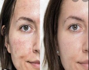 microneed7 - Elmira Studio Before and after photos of a woman's skin.