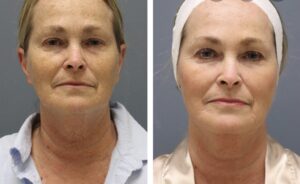 microneed8 - Elmira Studio A woman's face before and after liposuction.