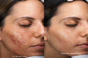 Tixel-Results-Acne-1 - Elmira Studio A woman with acne scars before and after treatment.