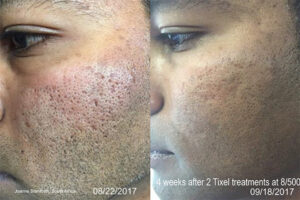 Tixel-Results-Acne-2 - Elmira Studio A man's skin before and after treatment.