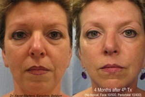 Tixel-Results-Face-Wrinkles - Elmira Studio Tixel Results Face Wrinkles