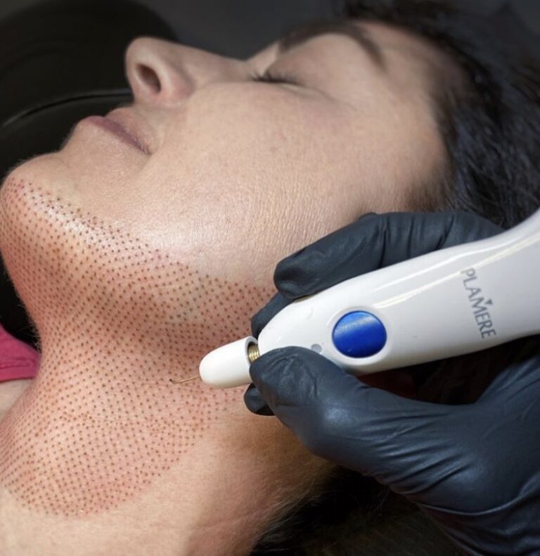 File_003-768x790 - Elmira Studio A woman is getting a laser treatment on her face.