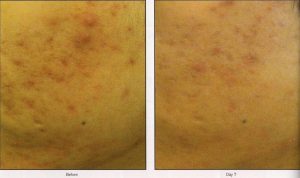 Acne scars before and after treatment.