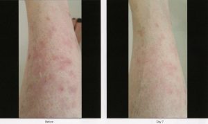 010 - Elmira Studio Psoriasis before and after treatment.
