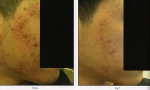 011 - Elmira Studio A man's face with acne before and after treatment.