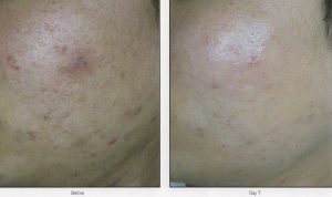 012 - Elmira Studio A man's face with acne before and after treatment.