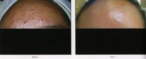 013 - Elmira Studio Before and after pictures of a man with acne.