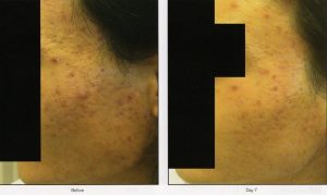 014 - Elmira Studio A woman's face before and after a chemical peel.