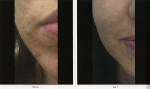 015 - Elmira Studio Before and after photos of a woman with acne.