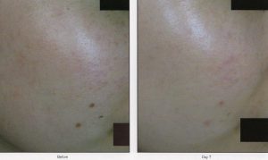 016 - Elmira Studio Before and after photos of a woman's skin.