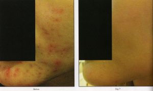 017 - Elmira Studio Acne scars before and after treatment.