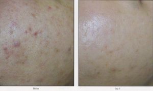 018 - Elmira Studio Acne scars before and after treatment.