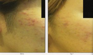 A woman's face with acne before and after treatment.