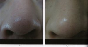 Before and after photos of a person's nose.