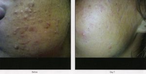 020 - Elmira Studio Acne scars before and after treatment.
