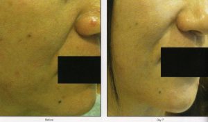 021 - Elmira Studio Before and after photo of a woman's face.