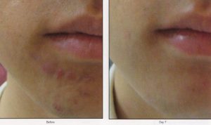 Before and after pictures of a man's face.